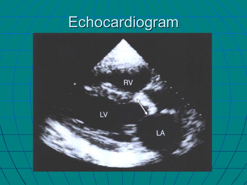 Echocardiogram